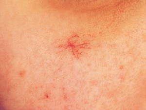 spider-angioma-pictures-6